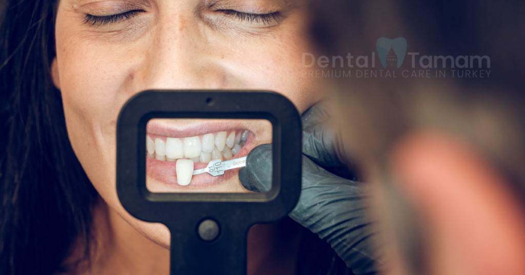 Veneers Cost in Turkey
