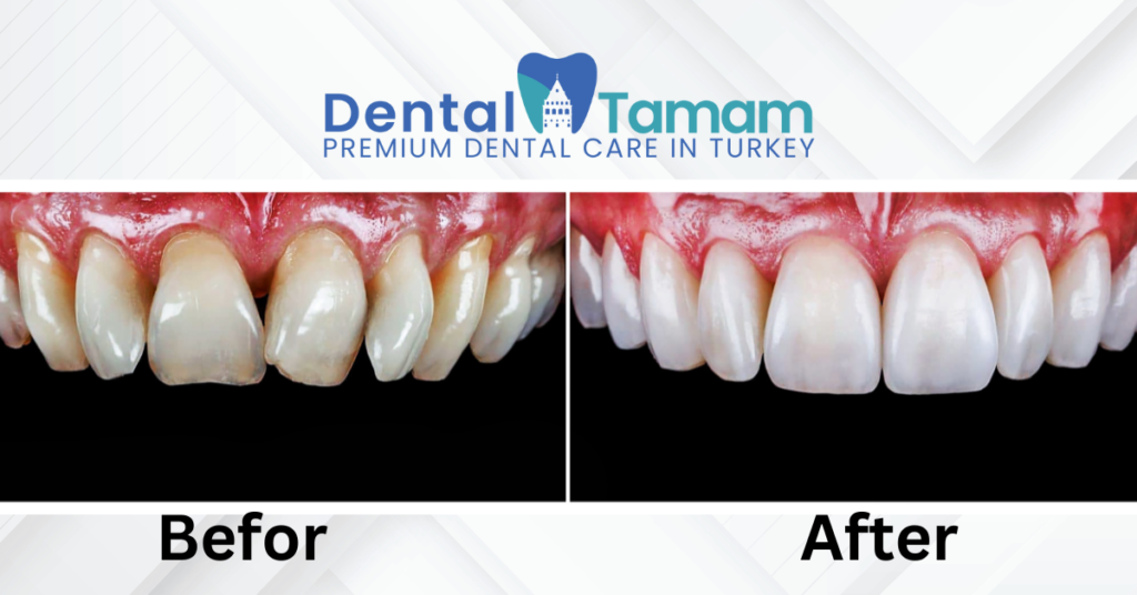 Veneers Cost in Turkey